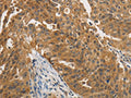 The image on the left is immunohistochemistry of paraffin-embedded Human ovarian cancer tissue using CSB-PA223710(PTPN11 Antibody) at dilution 1/25, on the right is treated with fusion protein. (Original magnification: ×200)