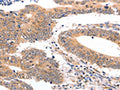 The image on the left is immunohistochemistry of paraffin-embedded Human colon cancer tissue using CSB-PA223916(SEMA3G Antibody) at dilution 1/30, on the right is treated with fusion protein. (Original magnification: ×200)