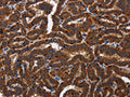 The image on the left is immunohistochemistry of paraffin-embedded Human thyroid cancer tissue using CSB-PA224064(TICAM2 Antibody) at dilution 1/60, on the right is treated with fusion protein. (Original magnification: ×200)