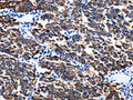 The image on the left is immunohistochemistry of paraffin-embedded Human breast cancer tissue using CSB-PA224586(KRT6A Antibody) at dilution 1/25, on the right is treated with fusion protein. (Original magnification: ×200)
