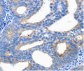 Immunohistochemical analysis of paraffin-embedded Human cervical cancer tissue using at dilution 1/25.