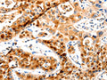 The image on the left is immunohistochemistry of paraffin-embedded Human lung cancer tissue using CSB-PA224661(MAP2K2 Antibody) at dilution 1/20, on the right is treated with synthetic peptide. (Original magnification: ×200)