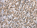 The image on the left is immunohistochemistry of paraffin-embedded Human esophagus cancer tissue using CSB-PA225115(ADNP Antibody) at dilution 1/15, on the right is treated with synthetic peptide. (Original magnification: ×200)