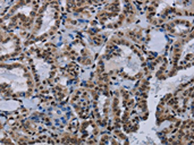 The image on the left is immunohistochemistry of paraffin-embedded Human thyroid cancer tissue using CSB-PA225274(HMGB1 Antibody) at dilution 1/30, on the right is treated with synthetic peptide. (Original magnification: ×200)