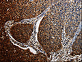 The image on the left is immunohistochemistry of paraffin-embedded Human renal cancer tissue using CSB-PA225375(BID Antibody) at dilution 1/25, on the right is treated with fusion protein. (Original magnification: ×200)