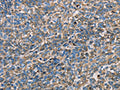 The image on the left is immunohistochemistry of paraffin-embedded Human ovarian cancer tissue using CSB-PA225650(APOA1 Antibody) at dilution 1/25, on the right is treated with fusion protein. (Original magnification: ×200)