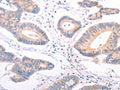The image on the left is immunohistochemistry of paraffin-embedded Human colon cancer tissue using CSB-PA225678(F9 Antibody) at dilution 1/45, on the right is treated with fusion protein. (Original magnification: ×200)