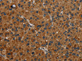 The image on the left is immunohistochemistry of paraffin-embedded Human liver cancer tissue using CSB-PA225804(NR3C1 Antibody) at dilution 1/30, on the right is treated with fusion protein. (Original magnification: ×200)