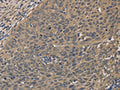 The image on the left is immunohistochemistry of paraffin-embedded Human cervical cancer tissue using CSB-PA225962(HSF1 Antibody) at dilution 1/60, on the right is treated with fusion protein. (Original magnification: ×200)