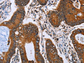 The image on the left is immunohistochemistry of paraffin-embedded Human colon cancer tissue using CSB-PA226317(IHH Antibody) at dilution 1/30, on the right is treated with fusion protein. (Original magnification: ×200)
