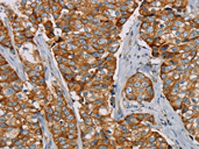 The image on the left is immunohistochemistry of paraffin-embedded Human breast cancer tissue using CSB-PA226880(TLR6 Antibody) at dilution 1/25, on the right is treated with fusion protein. (Original magnification: ×200)