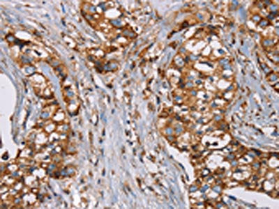 The image on the left is immunohistochemistry of paraffin-embedded Human breast cancer tissue using CSB-PA227378(NDUFS1 Antibody) at dilution 1/50, on the right is treated with fusion protein. (Original magnification: ×200)