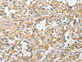 The image on the left is immunohistochemistry of paraffin-embedded Human thyroid cancer tissue using CSB-PA227449(APPBP2 Antibody) at dilution 1/30, on the right is treated with fusion protein. (Original magnification: ×200)