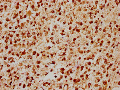 IHC image of CSB-PA22769A0Rb diluted at 1:200 and staining in paraffin-embedded human glioma performed on a Leica BondTM system. After dewaxing and hydration, antigen retrieval was mediated by high pressure in a citrate buffer (pH 6.0). Section was blocked with 10% normal goat serum 30min at RT. Then primary antibody (1% BSA) was incubated at 4°C overnight. The primary is detected by a biotinylated secondary antibody and visualized using an HRP conjugated SP system.