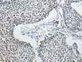 The image on the left is immunohistochemistry of paraffin-embedded Human lung cancer tissue using CSB-PA227771(AP2M1 Antibody) at dilution 1/15, on the right is treated with fusion protein. (Original magnification: ×200)