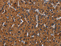 The image on the left is immunohistochemistry of paraffin-embedded Human liver cancer tissue using CSB-PA228825(KLK8 Antibody) at dilution 1/50, on the right is treated with fusion protein. (Original magnification: ×200)