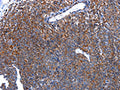 The image on the left is immunohistochemistry of paraffin-embedded Human ovarian cancer tissue using CSB-PA228918(HSPD1 Antibody) at dilution 1/30, on the right is treated with fusion protein. (Original magnification: ×200)