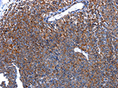 The image on the left is immunohistochemistry of paraffin-embedded Human ovarian cancer tissue using CSB-PA228918(HSPD1 Antibody) at dilution 1/30, on the right is treated with fusion protein. (Original magnification: ×200)
