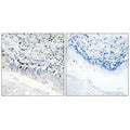 Immunohistochemistry analysis of paraffin-embedded human lung carcinoma tissue, using MED12 antibody.