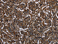 The image on the left is immunohistochemistry of paraffin-embedded Human liver cancer tissue using CSB-PA229264(HACL1 Antibody) at dilution 1/20, on the right is treated with fusion protein. (Original magnification: ×200)