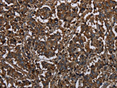 The image on the left is immunohistochemistry of paraffin-embedded Human liver cancer tissue using CSB-PA229264(HACL1 Antibody) at dilution 1/20, on the right is treated with fusion protein. (Original magnification: ×200)