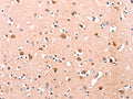 The image on the left is immunohistochemistry of paraffin-embedded Human brain tissue using CSB-PA229389(DUSP12 Antibody) at dilution 1/25, on the right is treated with fusion protein. (Original magnification: ×200)