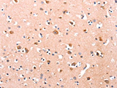 The image on the left is immunohistochemistry of paraffin-embedded Human brain tissue using CSB-PA229389(DUSP12 Antibody) at dilution 1/25, on the right is treated with fusion protein. (Original magnification: ×200)