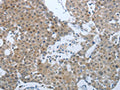 The image on the left is immunohistochemistry of paraffin-embedded Human breast cancer tissue using CSB-PA229849(CCL15 Antibody) at dilution 1/25, on the right is treated with synthetic peptide. (Original magnification: ×200)