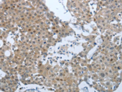 The image on the left is immunohistochemistry of paraffin-embedded Human breast cancer tissue using CSB-PA229849(CCL15 Antibody) at dilution 1/25, on the right is treated with synthetic peptide. (Original magnification: ×200)