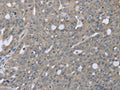 The image on the left is immunohistochemistry of paraffin-embedded Human ovarian cancer tissue using CSB-PA229873(BMX Antibody) at dilution 1/30, on the right is treated with fusion protein. (Original magnification: ×200)