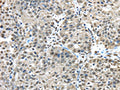 The image on the left is immunohistochemistry of paraffin-embedded Human breast cancer tissue using CSB-PA229936(FUS Antibody) at dilution 1/45, on the right is treated with fusion protein. (Original magnification: ×200)