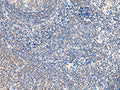The image on the left is immunohistochemistry of paraffin-embedded Human tonsil tissue using CSB-PA230617(GRB14 Antibody) at dilution 1/20, on the right is treated with fusion protein. (Original magnification: ×200)