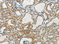 The image on the left is immunohistochemistry of paraffin-embedded Human thyroid cancer tissue using CSB-PA231814(AANAT Antibody) at dilution 1/40, on the right is treated with fusion protein. (Original magnification: ×200)