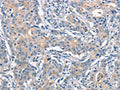 The image on the left is immunohistochemistry of paraffin-embedded Human gastic cancer tissue using CSB-PA231989(ANAPC1 Antibody) at dilution 1/15, on the right is treated with synthetic peptide. (Original magnification: ×200)