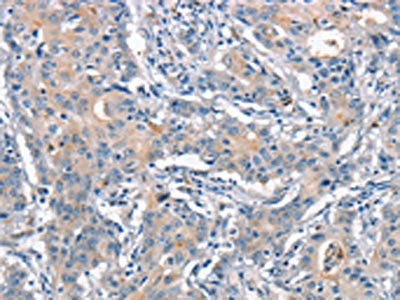 The image on the left is immunohistochemistry of paraffin-embedded Human gastic cancer tissue using CSB-PA231989(ANAPC1 Antibody) at dilution 1/15, on the right is treated with synthetic peptide. (Original magnification: ×200)
