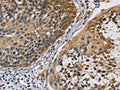 The image on the left is immunohistochemistry of paraffin-embedded Human cervical cancer tissue using CSB-PA232262(CBR1 Antibody) at dilution 1/40, on the right is treated with fusion protein. (Original magnification: ×200)