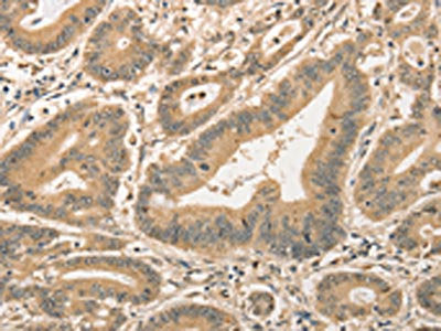 The image on the left is immunohistochemistry of paraffin-embedded Human colon cancer tissue using CSB-PA232587(CDCA8 Antibody) at dilution 1/40, on the right is treated with fusion protein. (Original magnification: ×200)