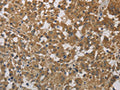 The image on the left is immunohistochemistry of paraffin-embedded Human thyroid cancer tissue using CSB-PA232766(CYB5A Antibody) at dilution 1/40, on the right is treated with fusion protein. (Original magnification: ×200)