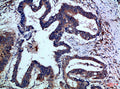 Immunohistochemical analysis of paraffin-embedded Human-colon-cancer, antibody was diluted at 1:100