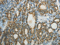 The image on the left is immunohistochemistry of paraffin-embedded Human thyroid cancer tissue using CSB-PA233120(CTSV Antibody) at dilution 1/50, on the right is treated with fusion protein. (Original magnification: ×200)