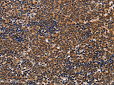 The image on the left is immunohistochemistry of paraffin-embedded Human lymphoma tissue using CSB-PA233146(ADH1A Antibody) at dilution 1/20, on the right is treated with fusion protein. (Original magnification: ×200)