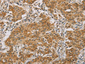 The image on the left is immunohistochemistry of paraffin-embedded Human gastic cancer tissue using CSB-PA233193(CDKN2A Antibody) at dilution 1/50, on the right is treated with synthetic peptide. (Original magnification: ×200)