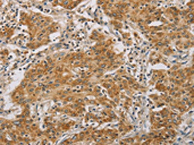 The image on the left is immunohistochemistry of paraffin-embedded Human gastic cancer tissue using CSB-PA233193(CDKN2A Antibody) at dilution 1/50, on the right is treated with synthetic peptide. (Original magnification: ×200)