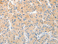 The image on the left is immunohistochemistry of paraffin-embedded Human liver cancer tissue using CSB-PA233350(RPN1 Antibody) at dilution 1/30, on the right is treated with fusion protein. (Original magnification: ×200)