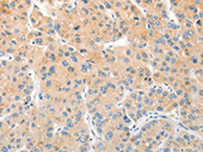 The image on the left is immunohistochemistry of paraffin-embedded Human liver cancer tissue using CSB-PA233350(RPN1 Antibody) at dilution 1/30, on the right is treated with fusion protein. (Original magnification: ×200)