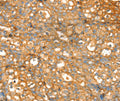 Immunohistochemical analysis of paraffin-embedded Human breast cancer tissue using at dilution 1/20.