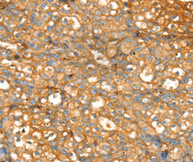 Immunohistochemical analysis of paraffin-embedded Human breast cancer tissue using at dilution 1/20.