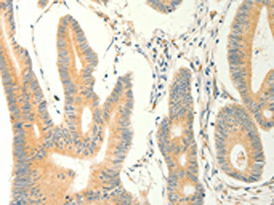 The image on the left is immunohistochemistry of paraffin-embedded Human colon cancer tissue using CSB-PA233398(ERG Antibody) at dilution 1/40, on the right is treated with fusion protein. (Original magnification: ×200)