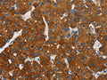 The image on the left is immunohistochemistry of paraffin-embedded Human liver cancer tissue using CSB-PA233585(CARD9 Antibody) at dilution 1/70, on the right is treated with fusion protein. (Original magnification: ×200)