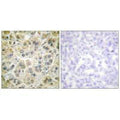 Immunohistochemistry analysis of paraffin-embedded human colon carcinoma tissue using Vimentin antibody.
